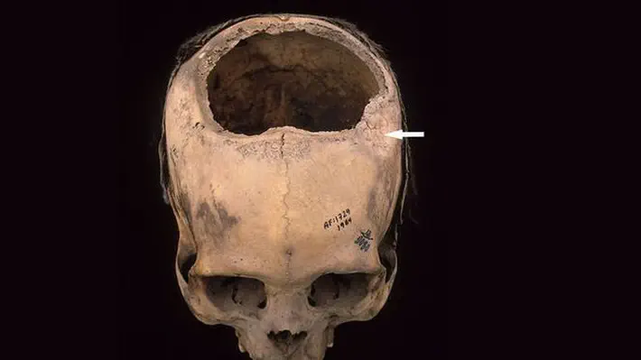 Cranial surgery without modern anesthesia and antibiotics may sound like a death sentence. But trepanation—the act of drilling, cutting, or scraping a hole in the skull for medical reasons—was practiced for thousands of years from ancient Greece to pre-Columbian Peru. Not every patient survived. But many did, including more than 100 subjects of the Inca Empire. A new study of their skulls and hundreds of others from pre-Columbian Peru suggests the success rates of premodern surgeons there was shockingly high: up to 80% during the Inca era, compared with just 50% during the American Civil War some 400 years later.